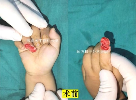 和平醫(yī)院成功為2歲男童實現(xiàn)“手指再生”_手外科醫(yī)院咨詢(圖1)