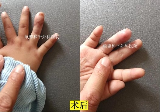 和平醫(yī)院成功為2歲男童實現(xiàn)“手指再生”_手外科醫(yī)院咨詢(圖2)