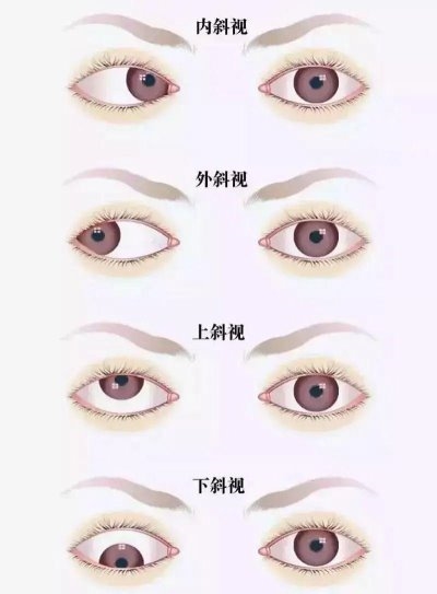 愛爾眼科：總愛偏頭看，視力“一好一壞”？警惕斜視！